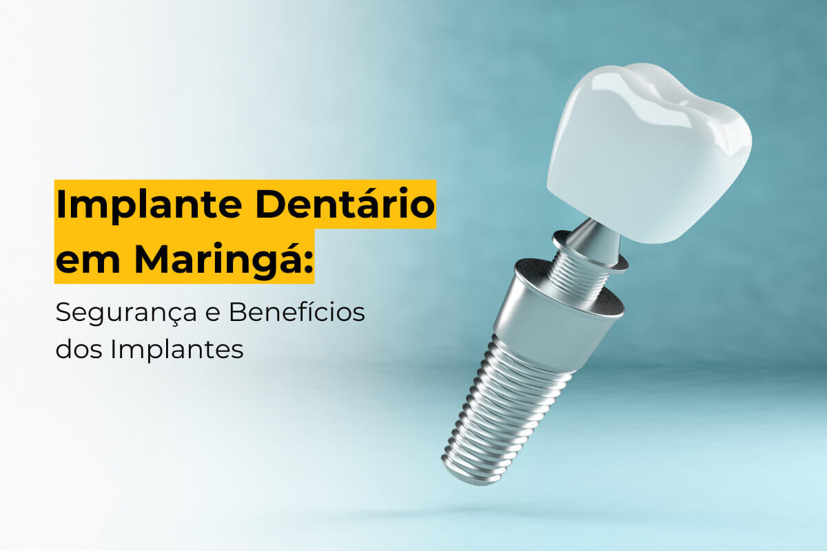 Implante Dentário Maringá: Segurança e Benefícios do Procedimento