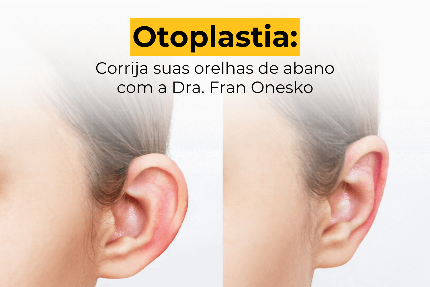 Otoplastia em Ipanema: Corrija Suas Orelhas de Abano com a Dra. Fran Onesko