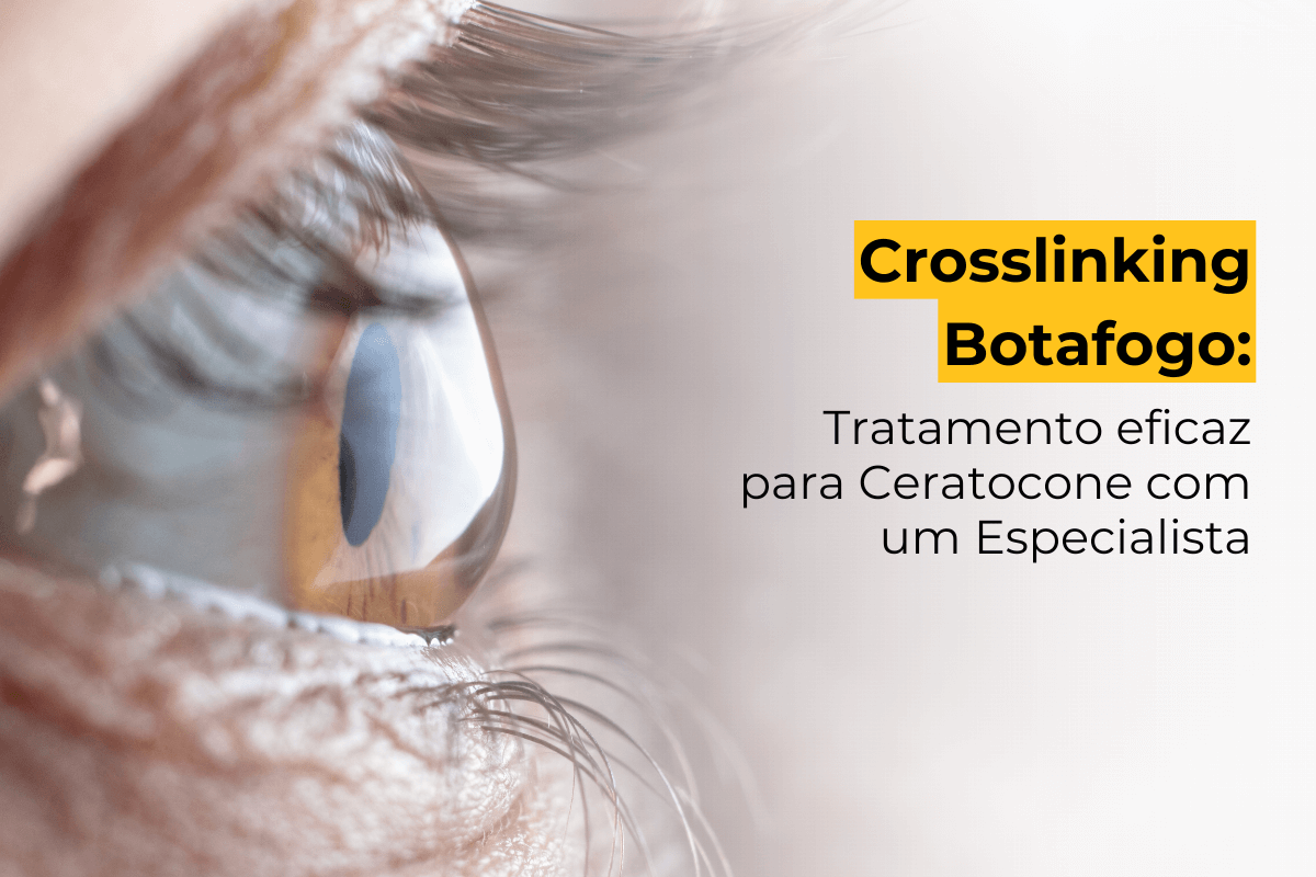 Crosslinking Botafogo: Tratamento Eficaz para Ceratocone com um Especialista