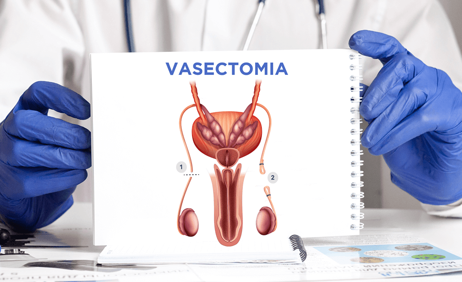 Vasectomia Maringá: Tudo o que Você Precisa Saber Sobre o Procedimento