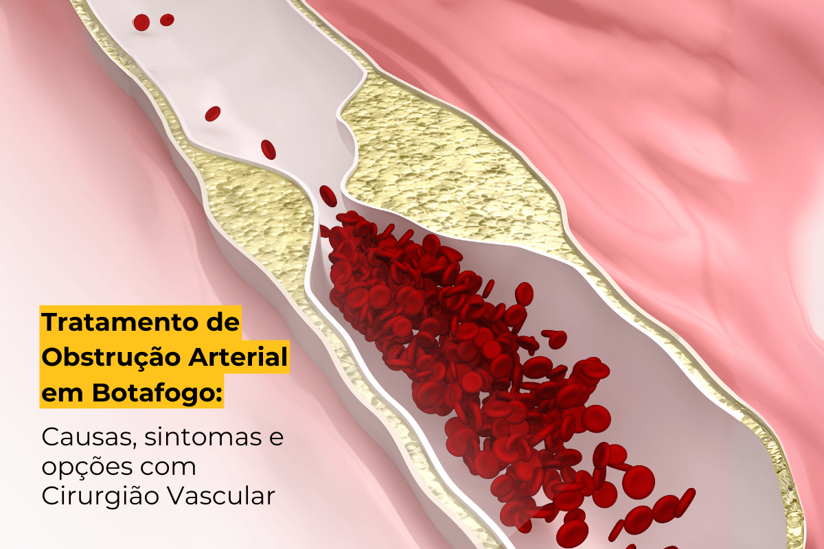 Tratamento de Obstrução Arterial em Botafogo: Causas, Sintomas e Opções com Cirurgião Vascular