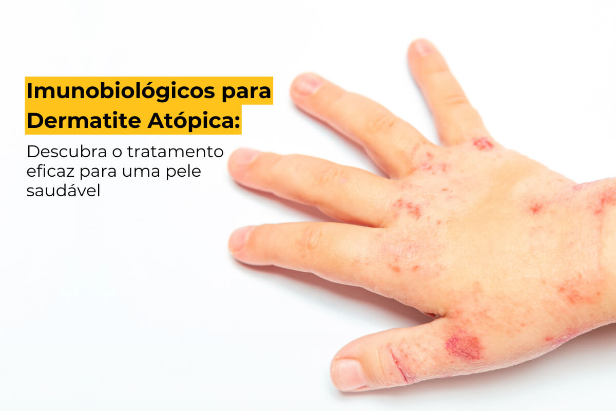 Imunobiológicos para Dermatite Atópica Maringá: Descubra o Tratamento Eficaz para uma Pele Saudável