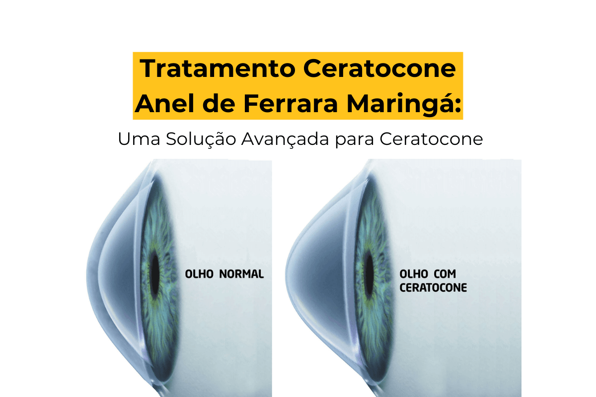 Tratamento Ceratocone Anel de Ferrara Maringá: Uma Solução Avançada para Ceratocone