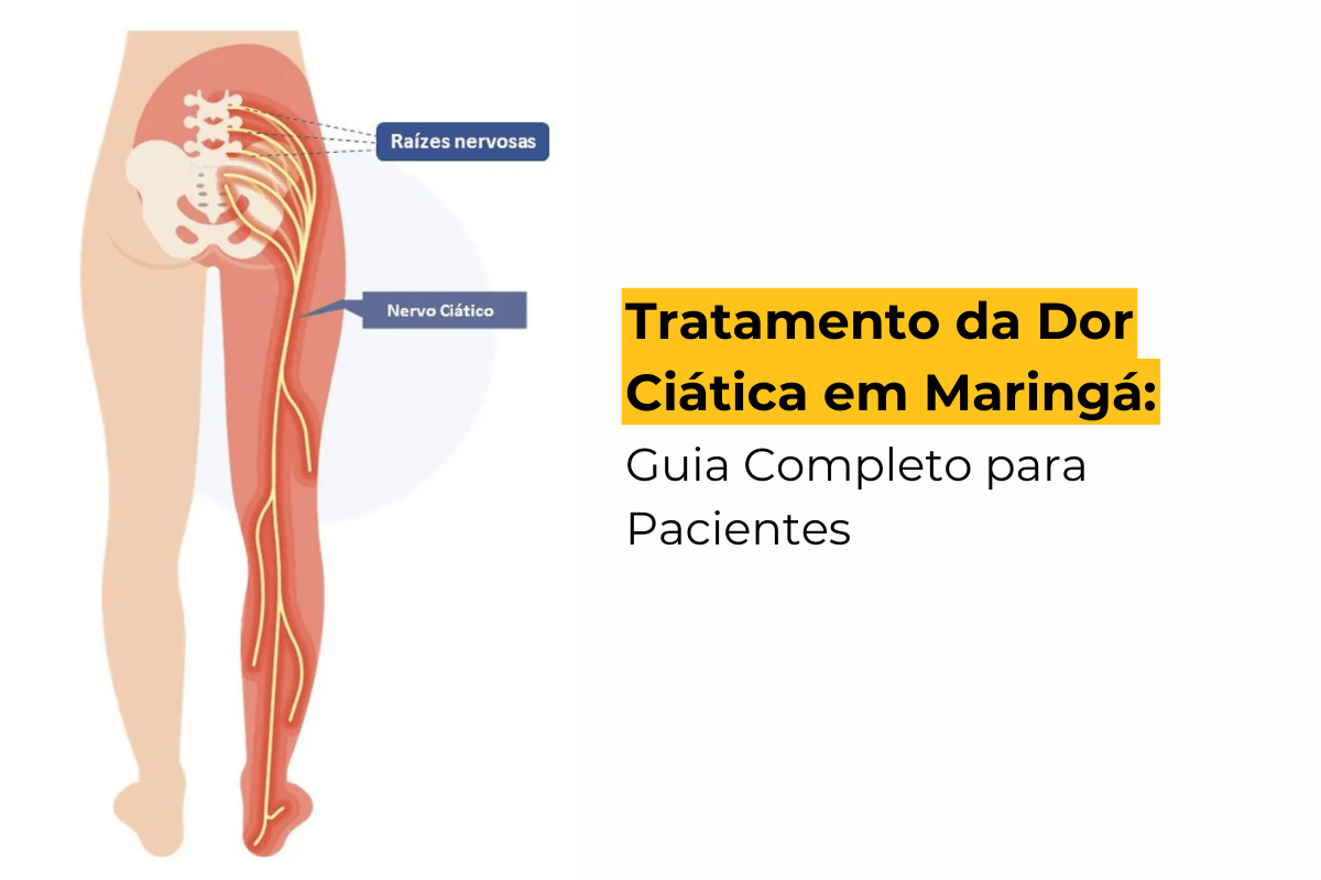 Tratamento da Dor Ciática em Maringá: Guia Completo para Pacientes