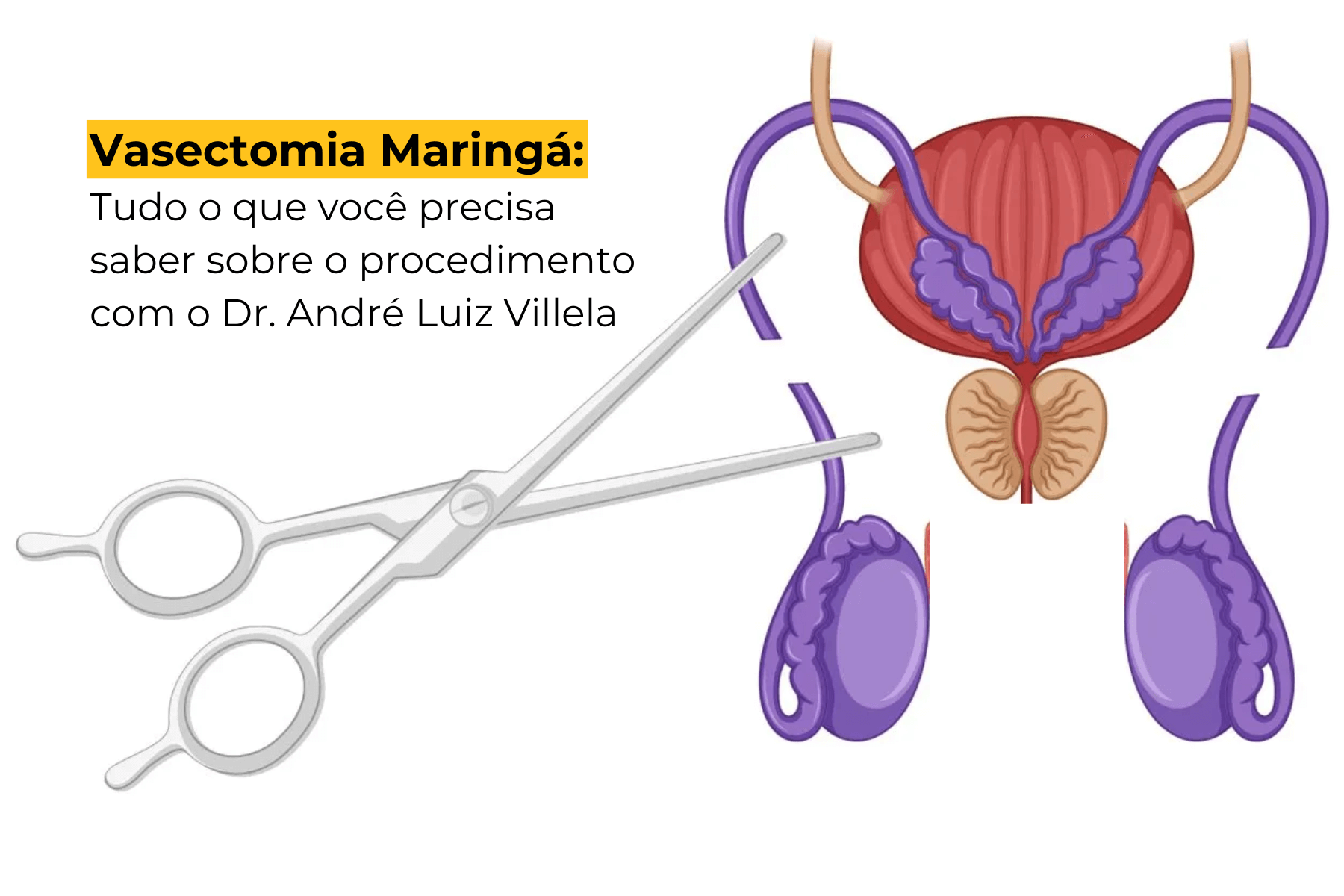 Vasectomia Maringá: Tudo o que Você Precisa Saber Sobre o Procedimento com o Dr. André Luiz Villela