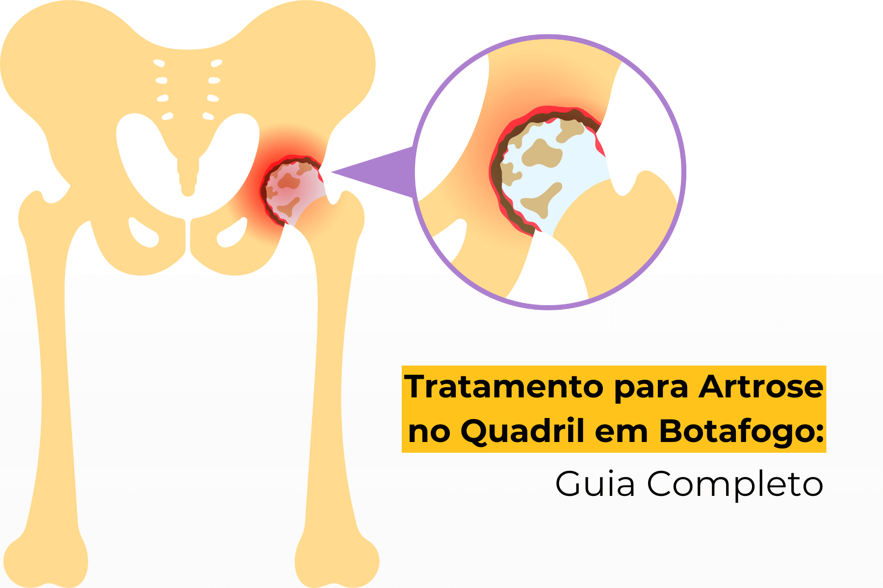 Tratamento para Artrose no Quadril em Botafogo: Guia Completo