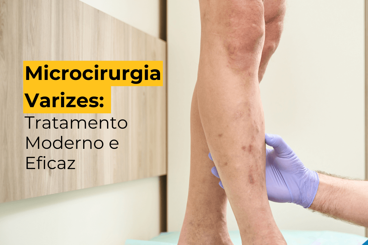 Microcirurgia Varizes Botafogo: Tratamento Moderno e Eficaz