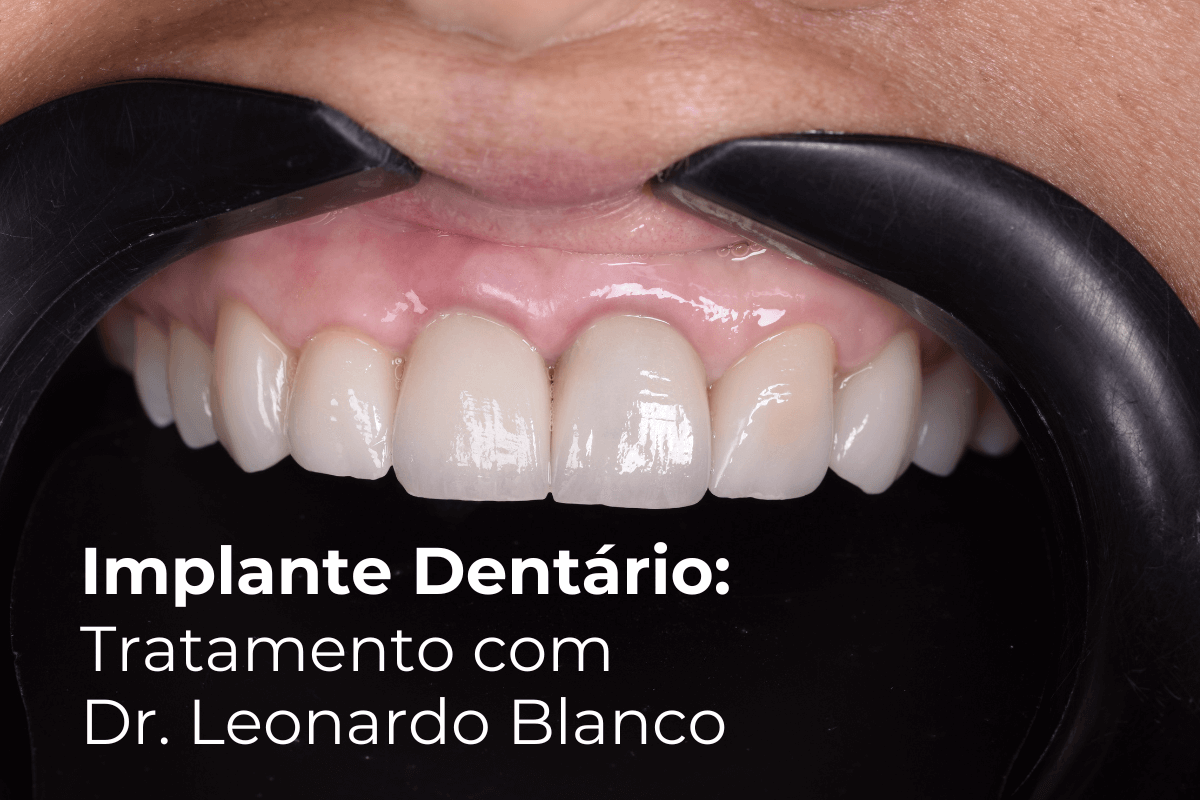 Implante Dentário em Maringá: Tratamento com Dr. Leonardo Blanco