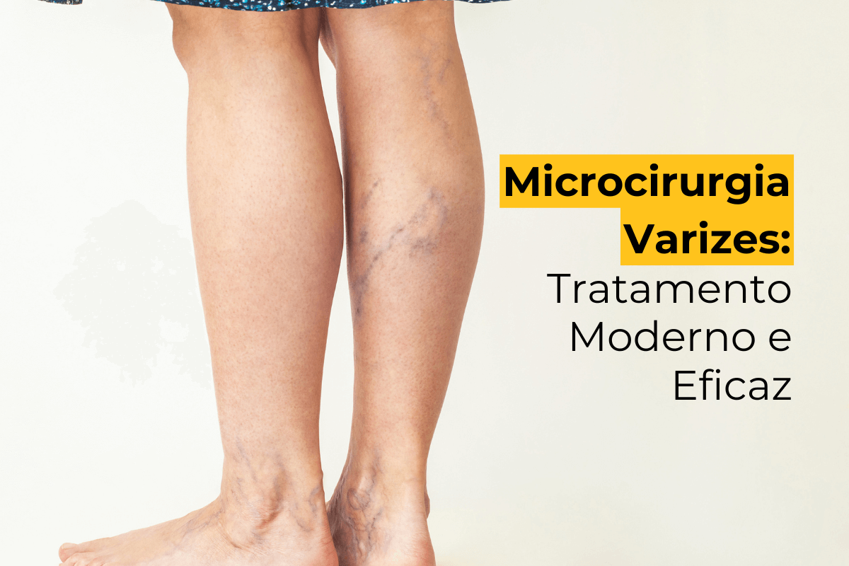 Microcirurgia Varizes Maringá: Tratamento Moderno e Eficaz