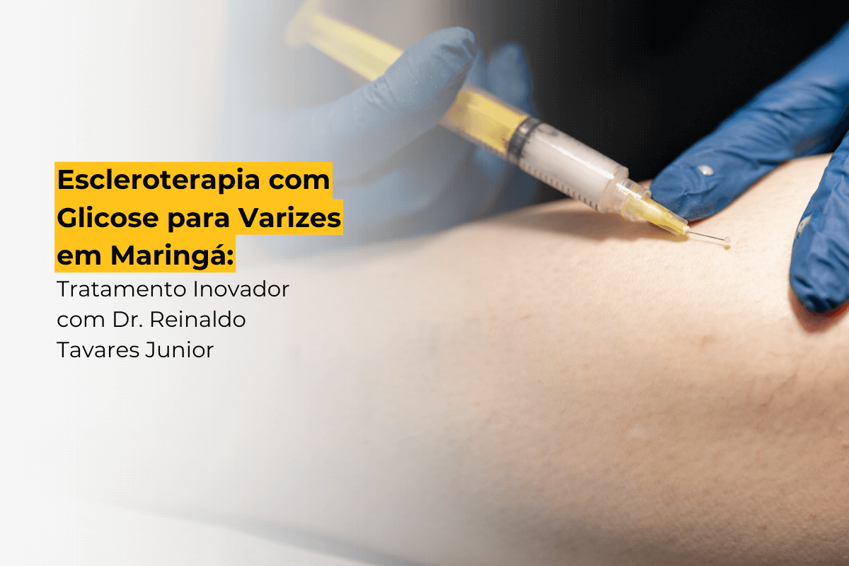 Escleroterapia com Glicose para Varizes em Maringá: Tratamento Inovador com Dr. Reinaldo Tavares Junior