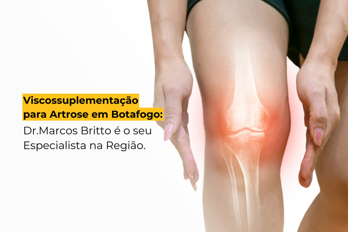 Viscossuplementação para Artrose em Botafogo: Dr. Marcos Britto é o seu Especialista na Região.