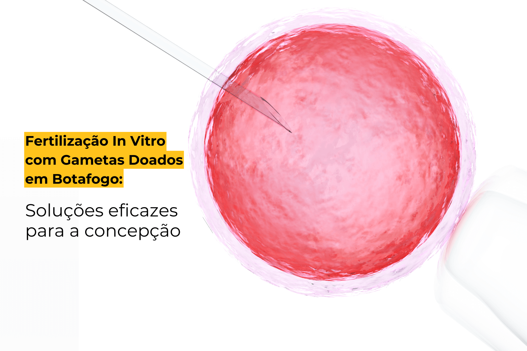 Fertilização In Vitro com Gametas Doados em Botafogo: Soluções Eficazes para a Concepção