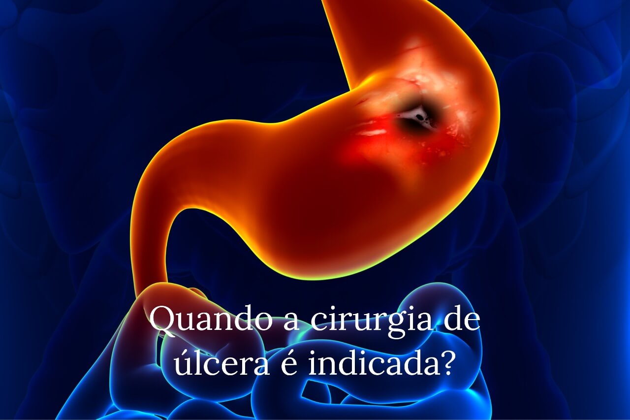 Quando a cirurgia de úlcera é indicada?