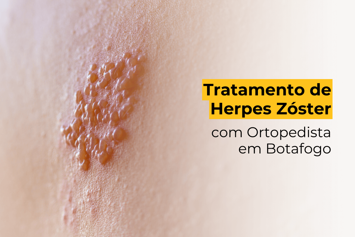 Tratamento de Herpes Zóster com Ortopedista em Botafogo