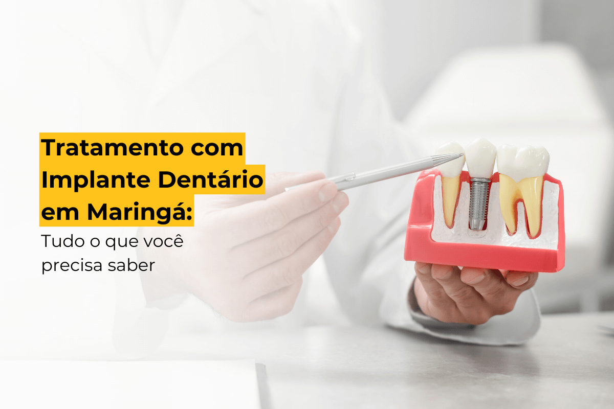 Tratamento com Implante Dentário em Maringá: Tudo o que Você Precisa Saber