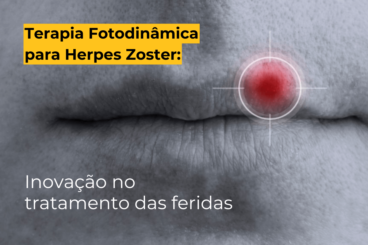 Terapia Fotodinâmica para Herpes Zoster em Maringá: Inovação