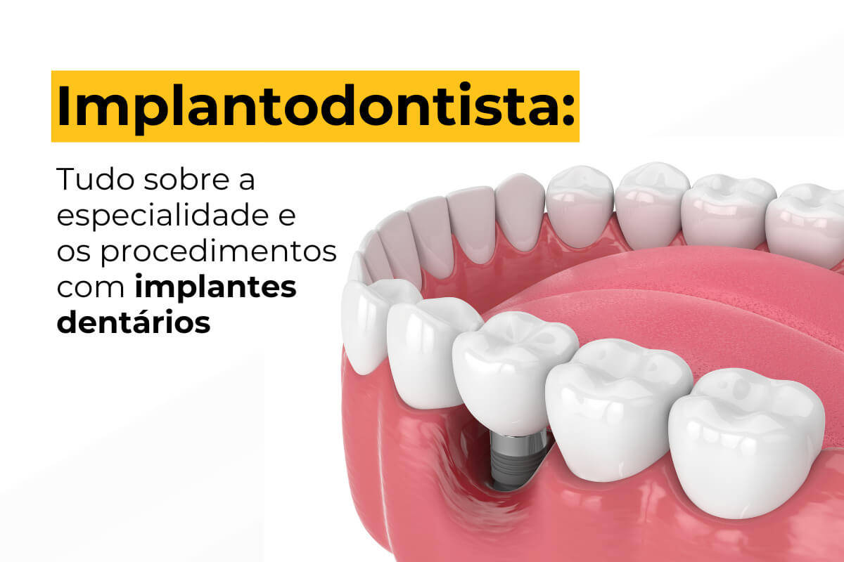 Implantodontista Maringá: Tudo Sobre a Especialidade e os Procedimentos com Implantes Dentários