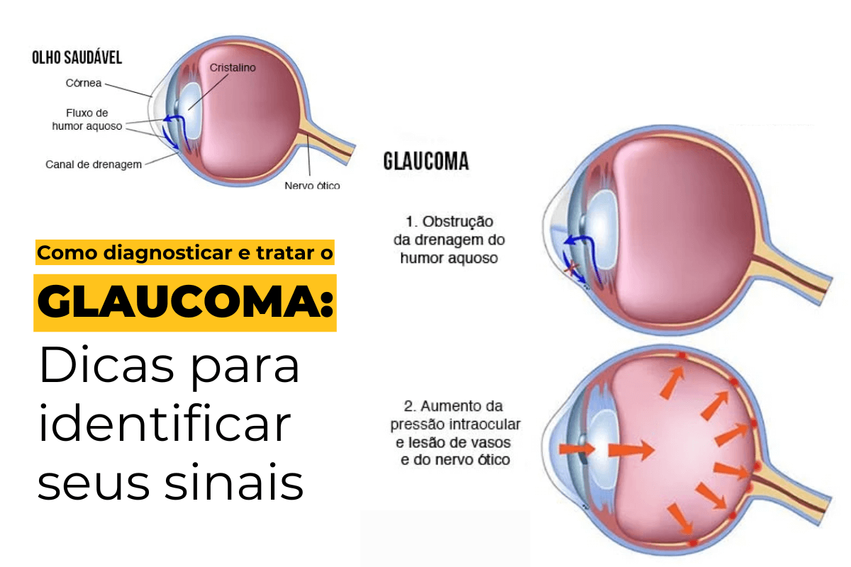 Como Diagnosticar e Tratar o Glaucoma em Maringá: Dicas para Identificar Seus Sinais