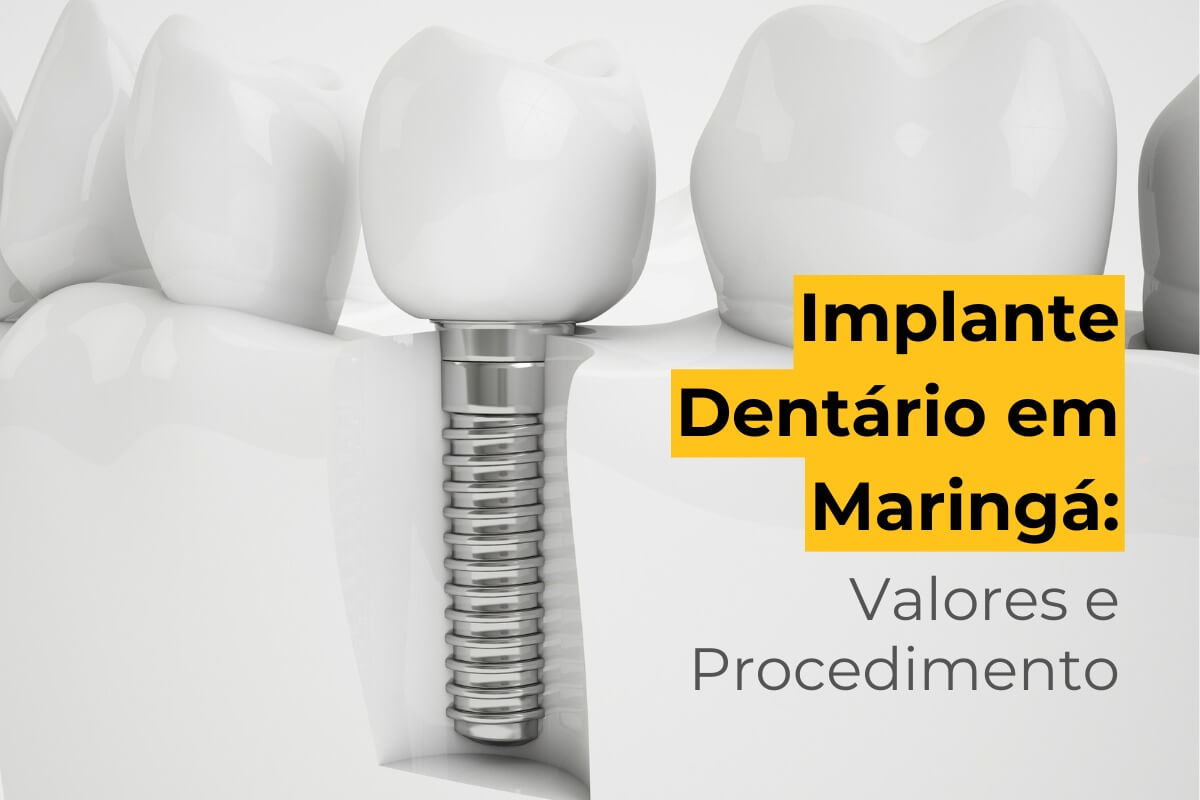 Implante Dentário em Maringá: Valores e Procedimento