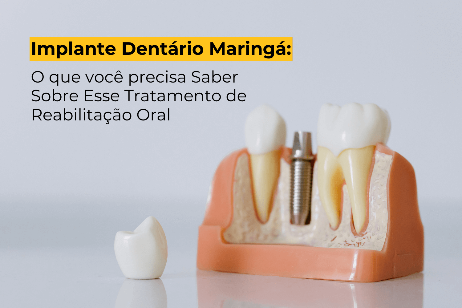 Implante Dentário Maringá: O Que Você Precisa Saber Sobre Esse Tratamento de Reabilitação Oral