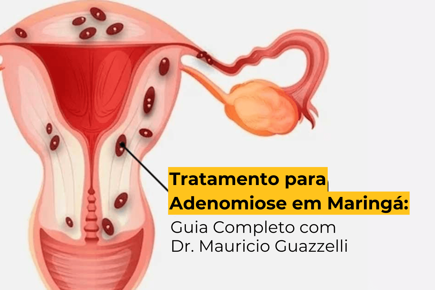 Tratamento para Adenomiose em Maringá: Guia Completo com Dr. Mauricio Guazzelli