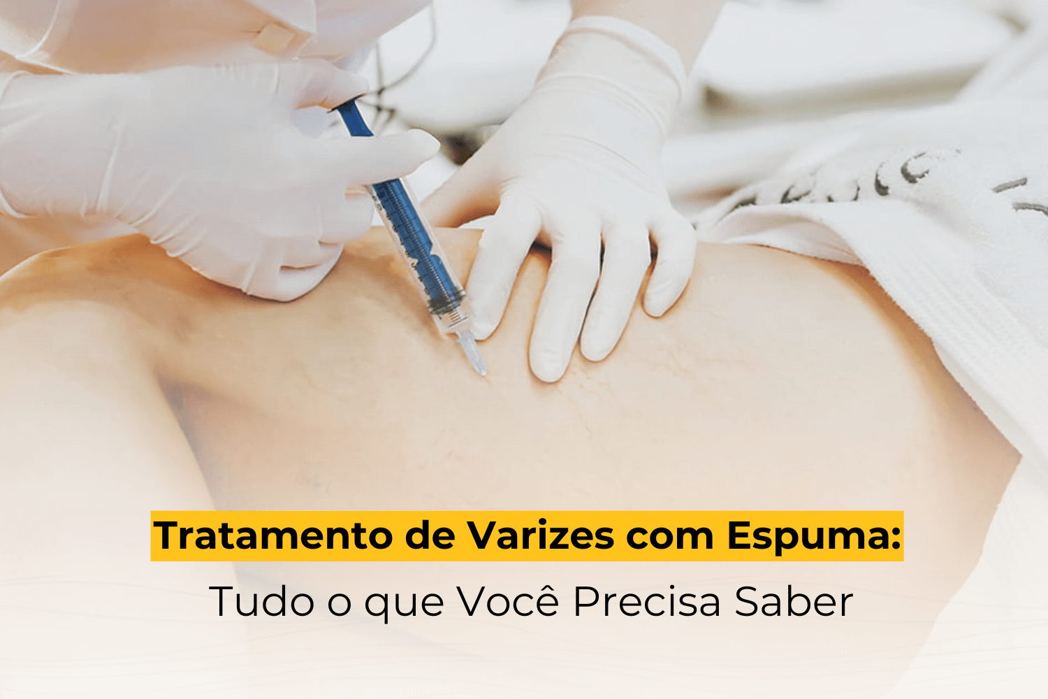 Tratamento de Varizes com Espuma: Tudo o que Você Precisa Saber