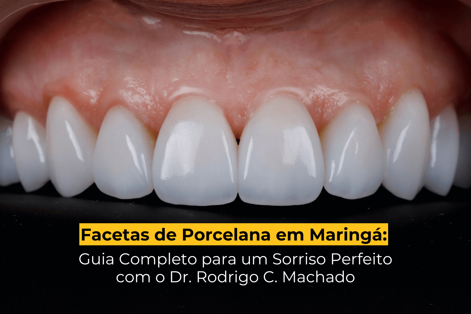 Facetas de Porcelana em Maringá: Guia Completo para um Sorriso Perfeito com o Dr. Rodrigo C. Machado