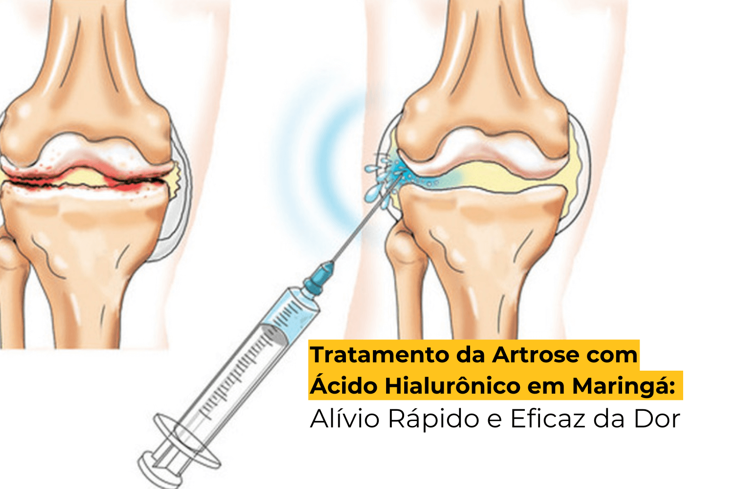 Tratamento da Artrose com Ácido Hialurônico em Maringá: Alívio Rápido e Eficaz da Dor