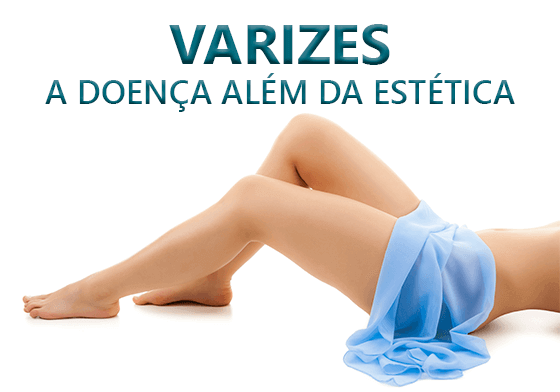 VARIZES – A DOENÇA ALÉM DA ESTÉTICA