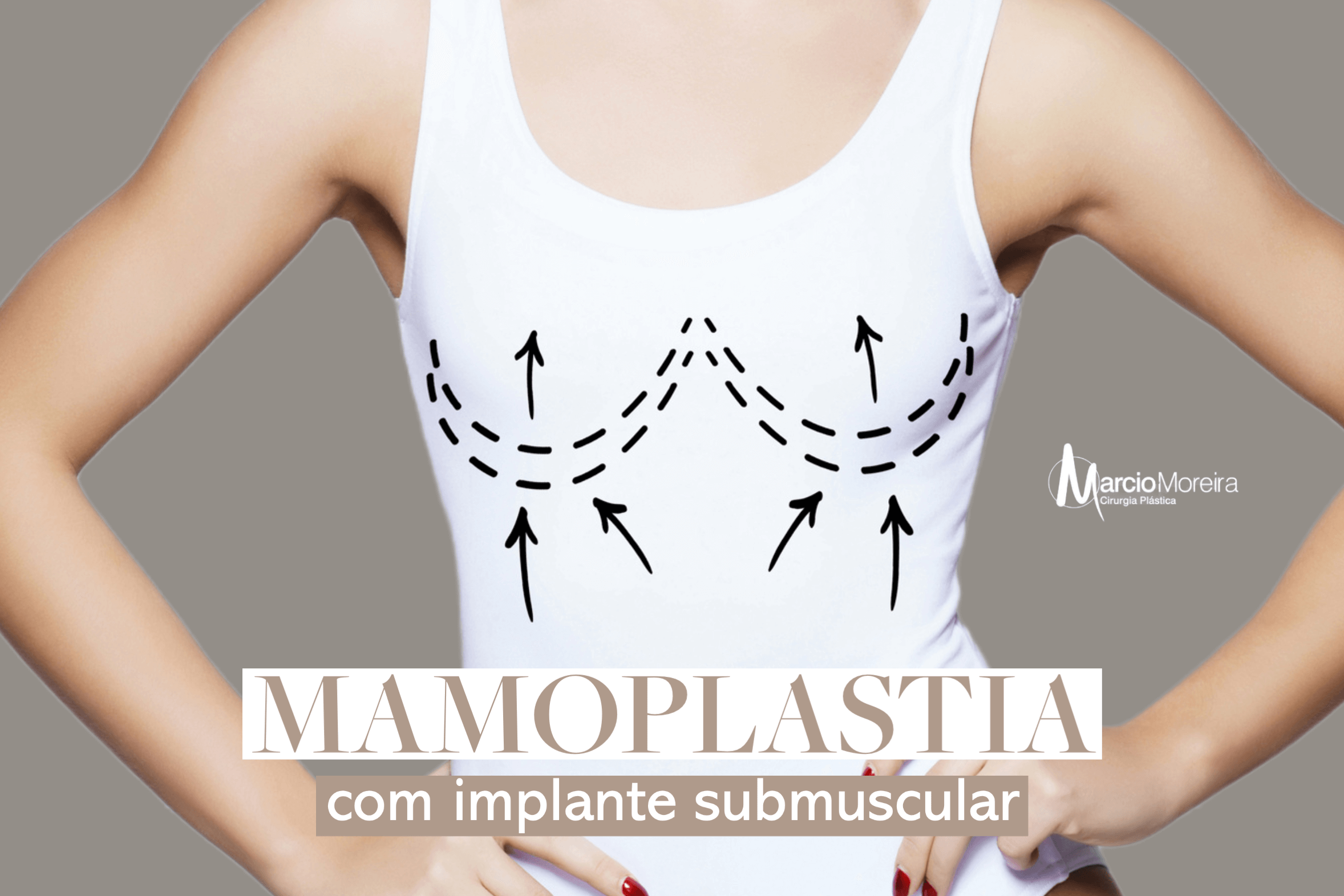 Mamoplastia Com Implante Submuscular Guia Saúde Cidades