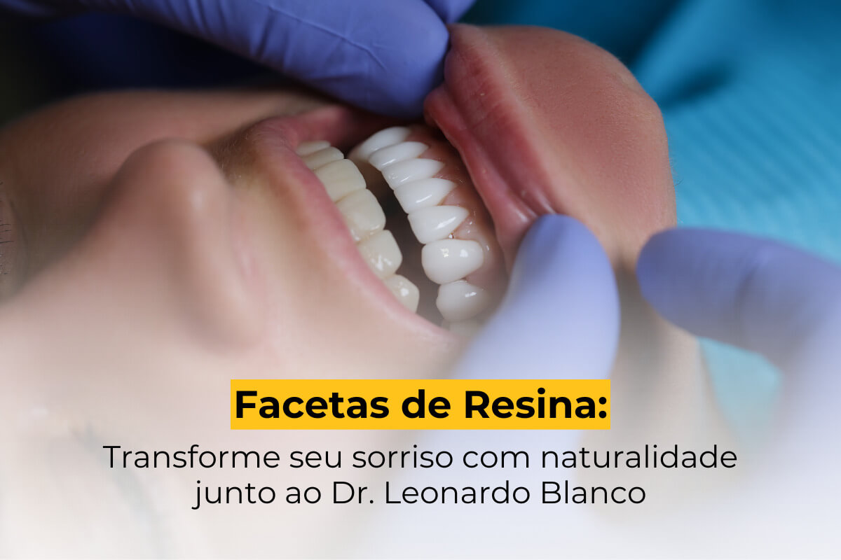 Facetas Dentais Maringá: Transforme seu Sorriso com Naturalidade Junto ao Dr. Leonardo Blanco