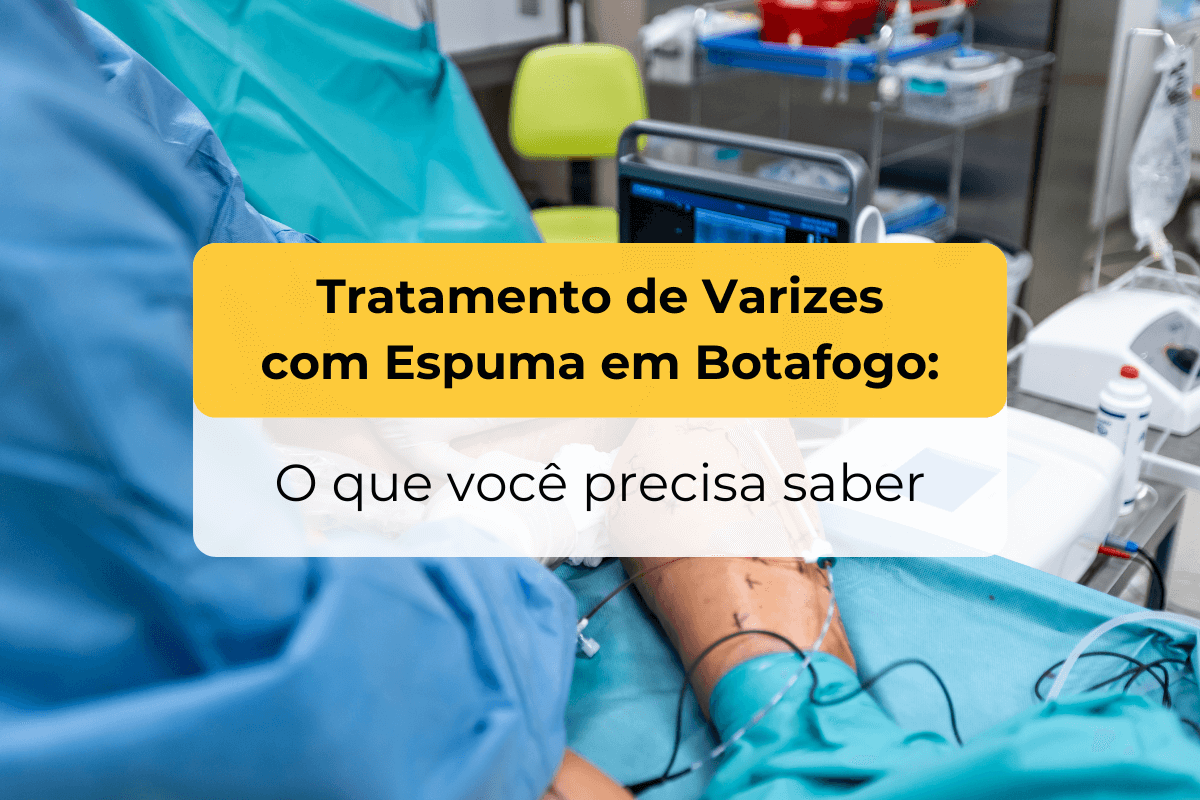 Tratamento de Varizes com Espuma em Botafogo: O Que Você Precisa Saber