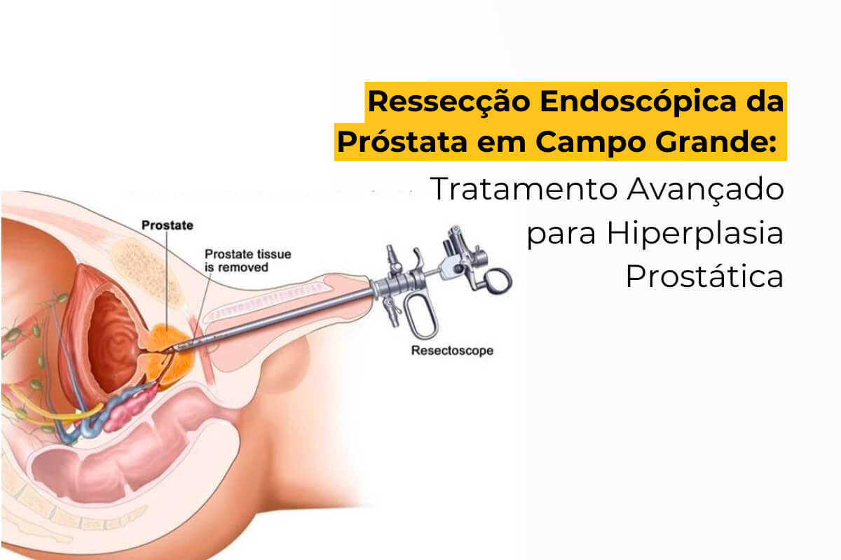 Ressecção Endoscópica da Próstata em Campo Grande: Tratamento Avançado para Hiperplasia Prostática