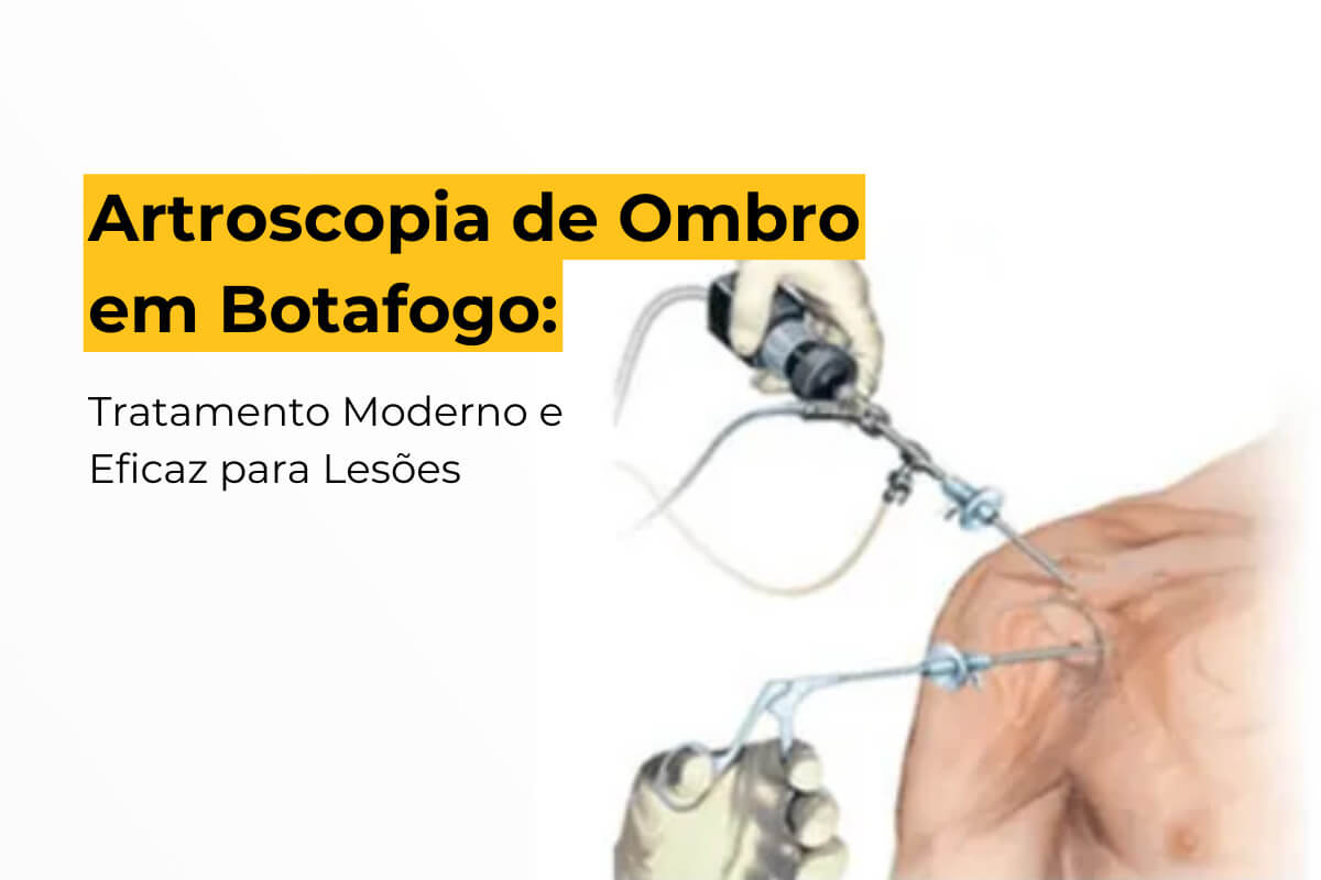 Artroscopia de Ombro em Botafogo: Tratamento Moderno e Eficaz para Lesões