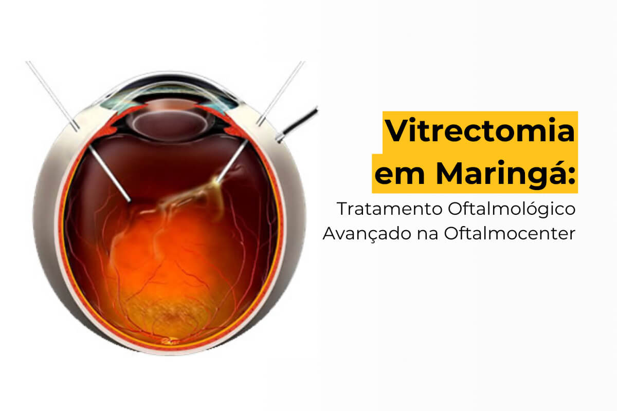 Vitrectomia em Maringá: Tratamento Oftalmológico Avançado na Oftalmocenter