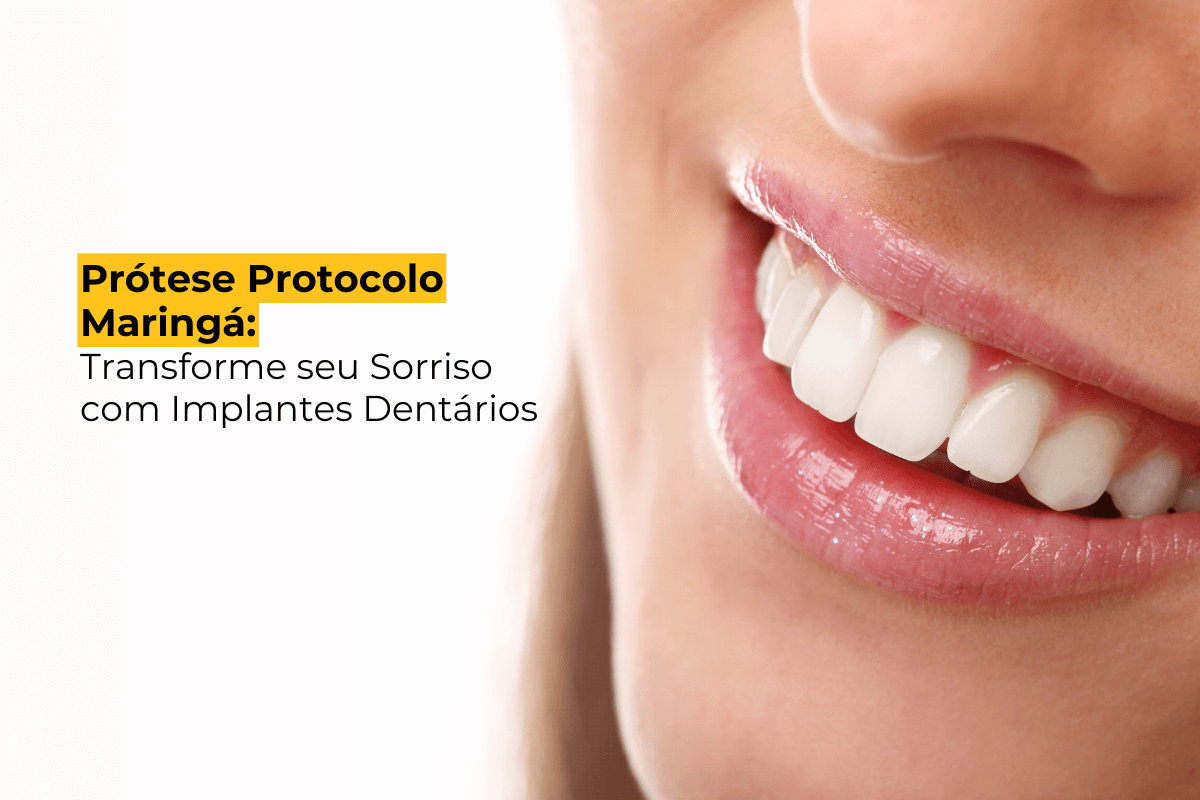 Prótese Protocolo Maringá: Transforme seu Sorriso com Implantes Dentários