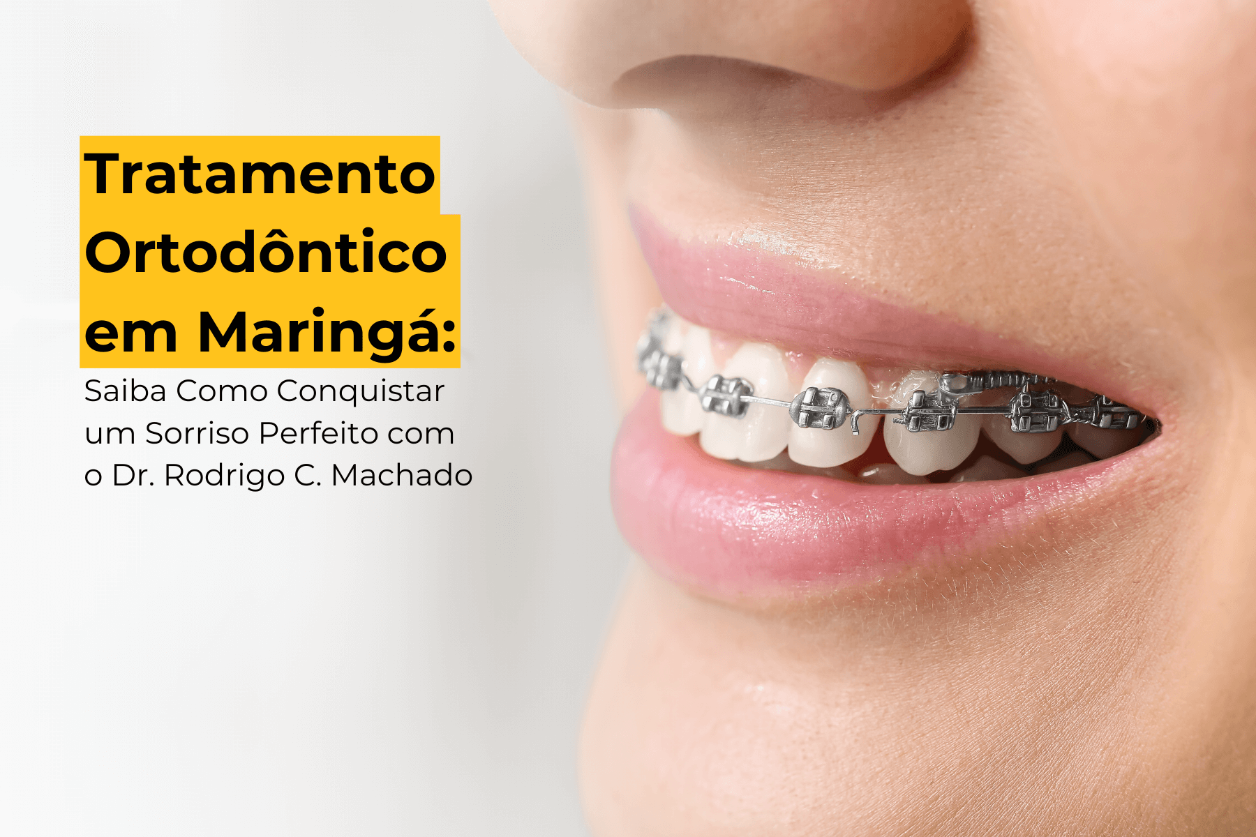 Tratamento Ortodôntico em Maringá: Saiba Como Conquistar um Sorriso Perfeito com o Dr. Rodrigo C. Machado