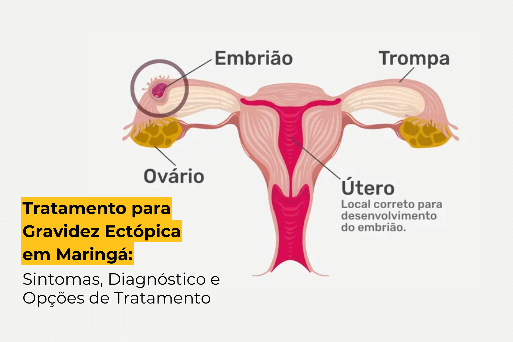 Tratamento para Gravidez Ectópica em Maringá: Sintomas, Diagnóstico e Opções de Tratamento