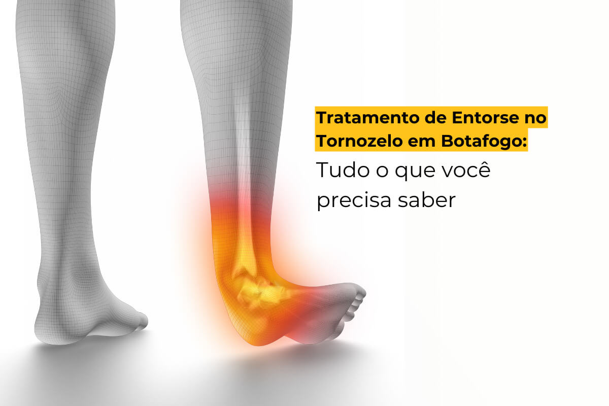 Tratamento de Entorse no Tornozelo em Botafogo: Tudo o que Você Precisa Saber