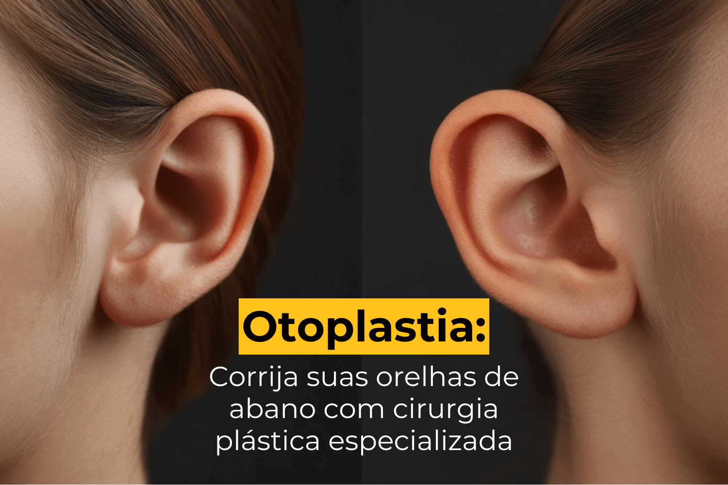 Otoplastia em Uberlândia: Corrija Suas Orelhas de Abano com Cirurgia Plástica Especializada