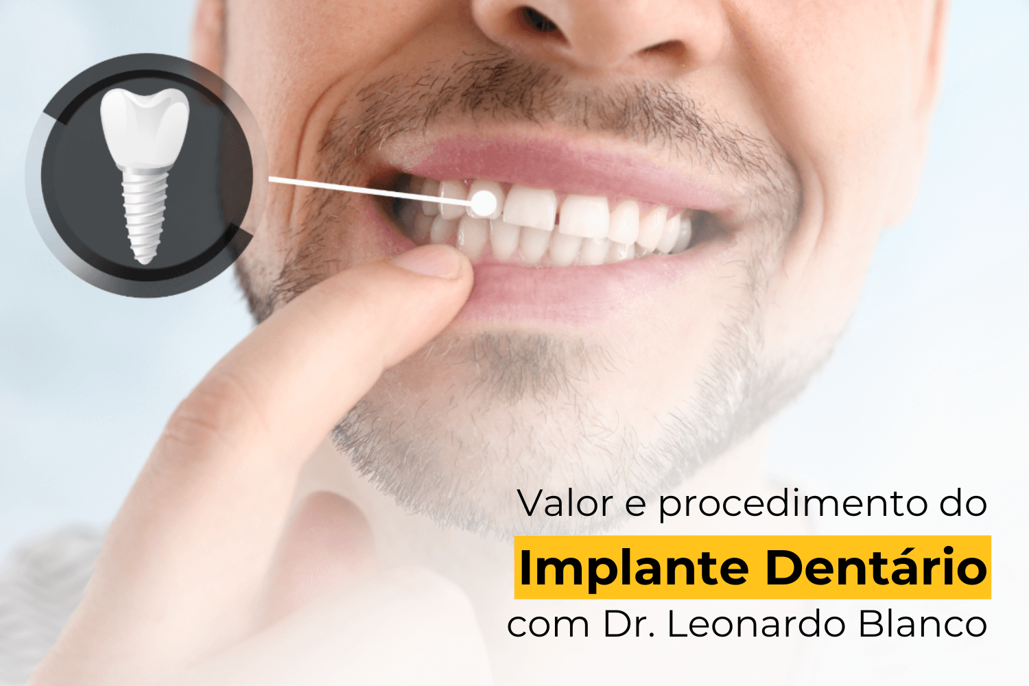 Valor e Procedimento do Implante Dentário em Maringá com Dr. Leonardo Blanco