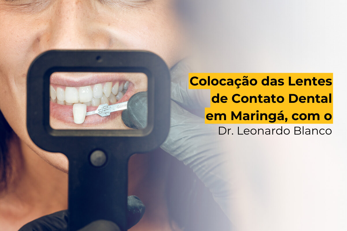 Colocação das Lentes de Contato Dental em Maringá, com o Dr. Leonardo Blanco