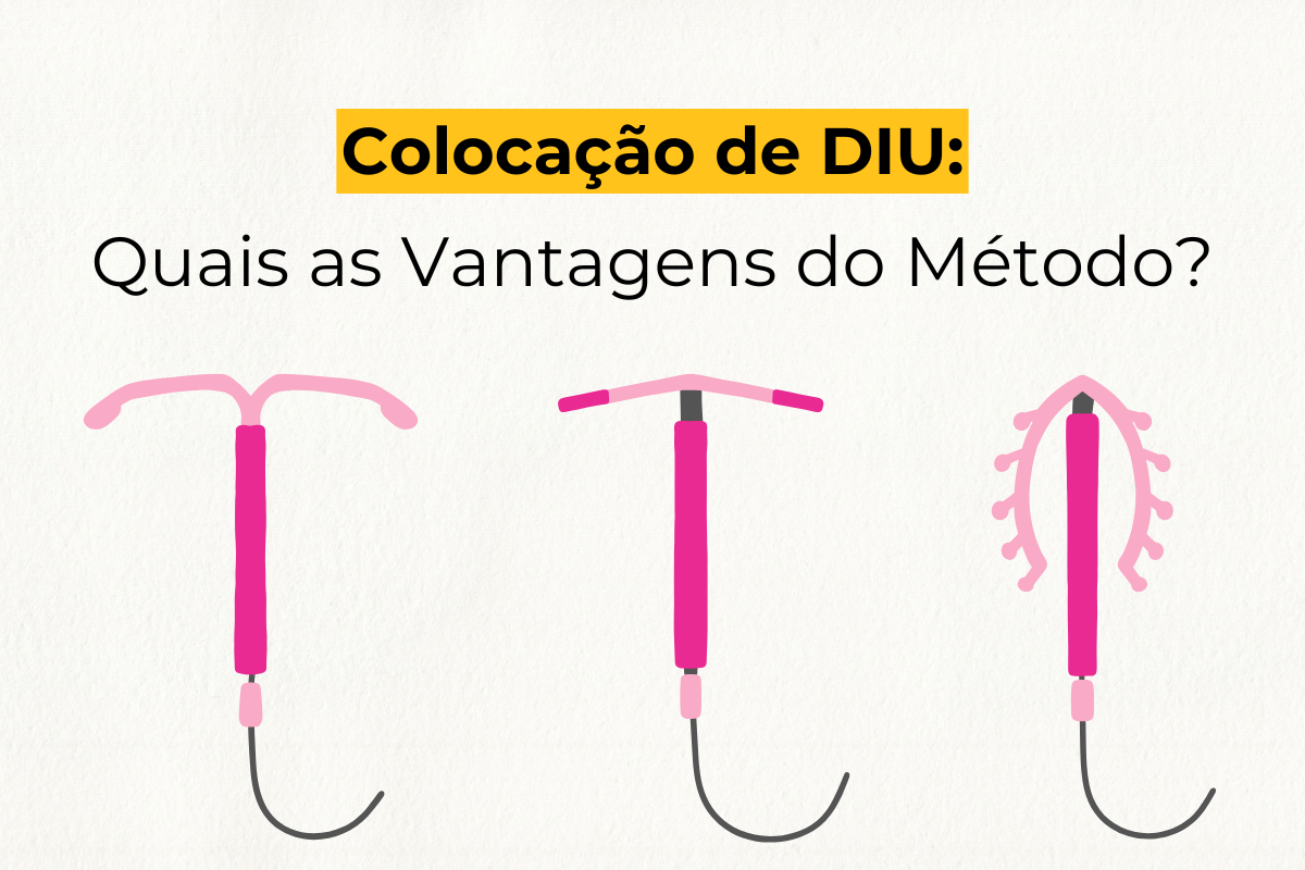 Colocação de DIU em Maringá: Quais as Vantagens do Método?