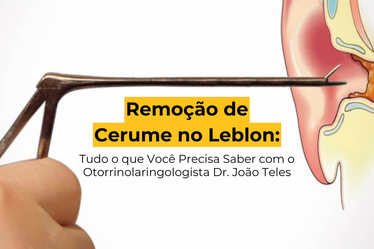 Remoção de Cerume no Leblon: Tudo o que Você Precisa Saber com o Otorrinolaringologista Dr. João Teles