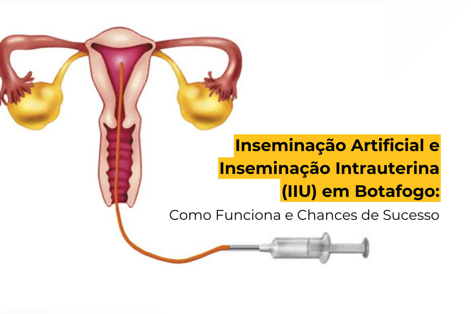 Inseminação Artificial e Inseminação Intrauterina (IIU) em Botafogo: Como Funciona e Chances de Sucesso