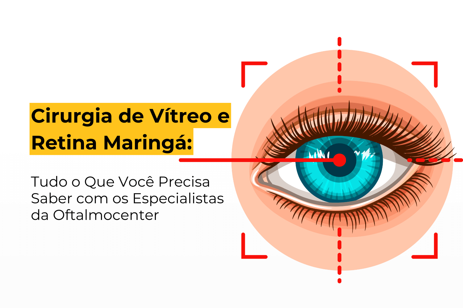 Cirurgia de Vítreo e Retina Maringá: Tudo o Que Você Precisa Saber com os Especialistas da Oftalmocenter