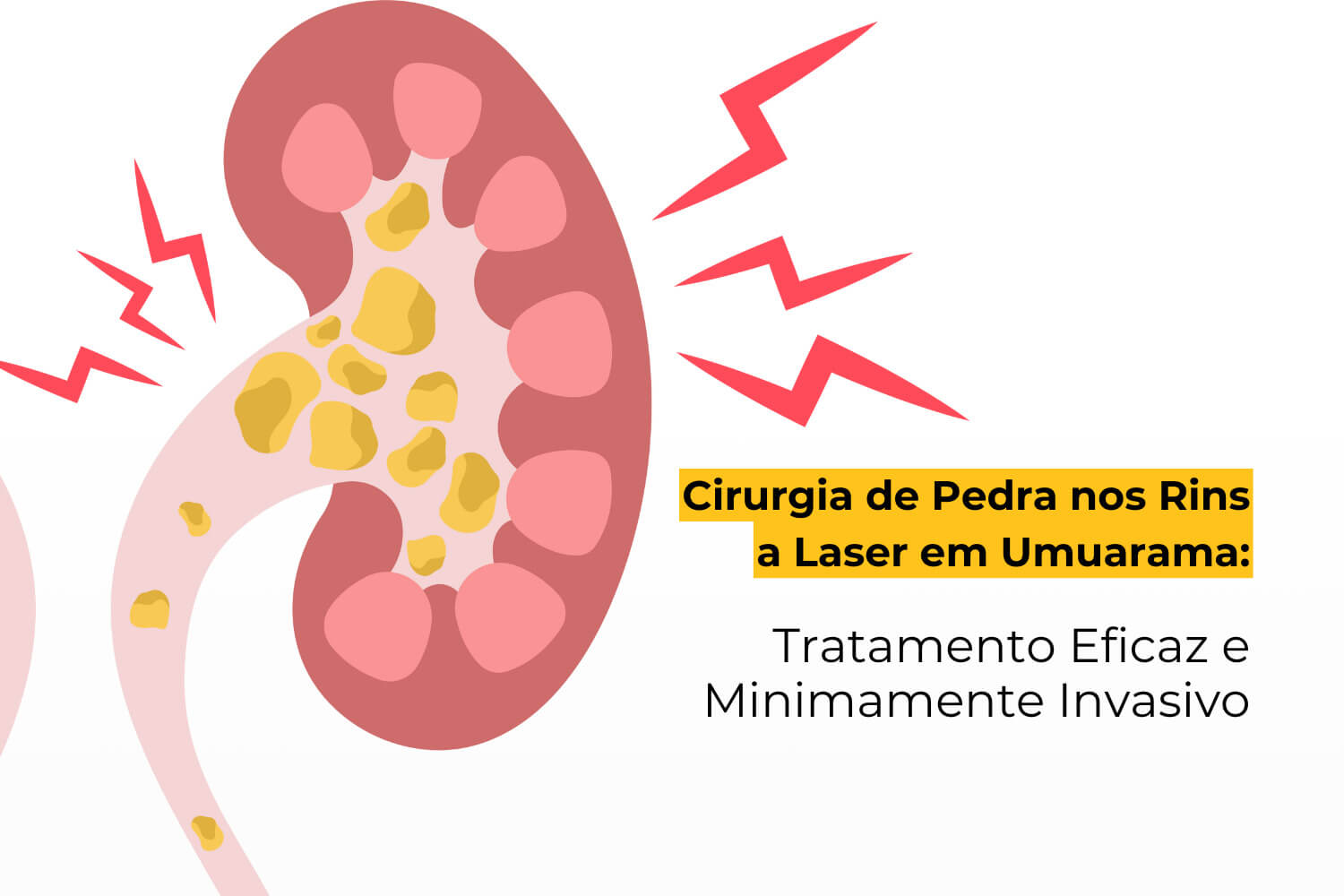 Cirurgia de Pedra nos Rins a Laser em Umuarama: Tratamento Eficaz e Minimamente Invasivo