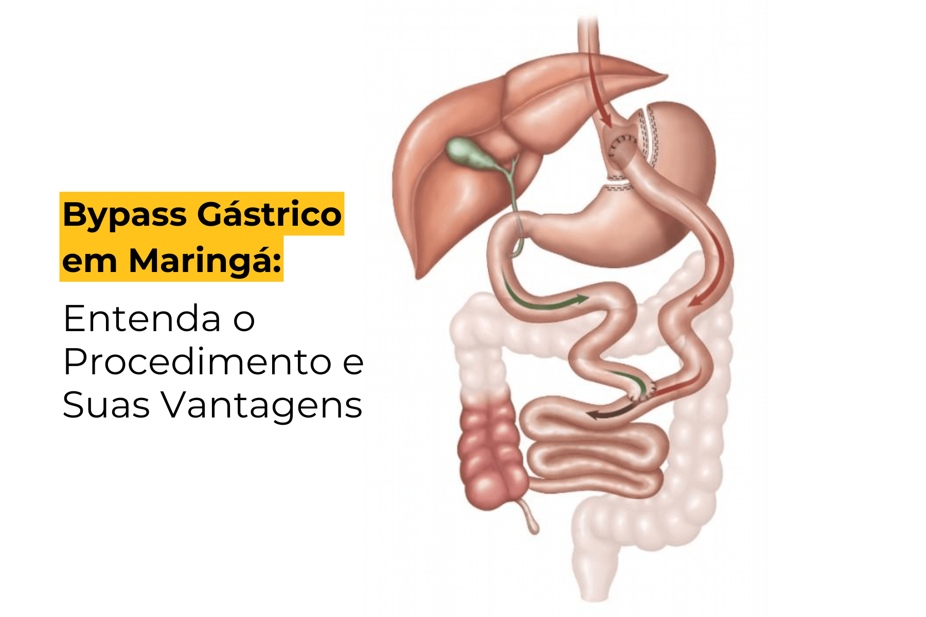 Bypass Gástrico em Maringá: Entenda o Procedimento e Suas Vantagens