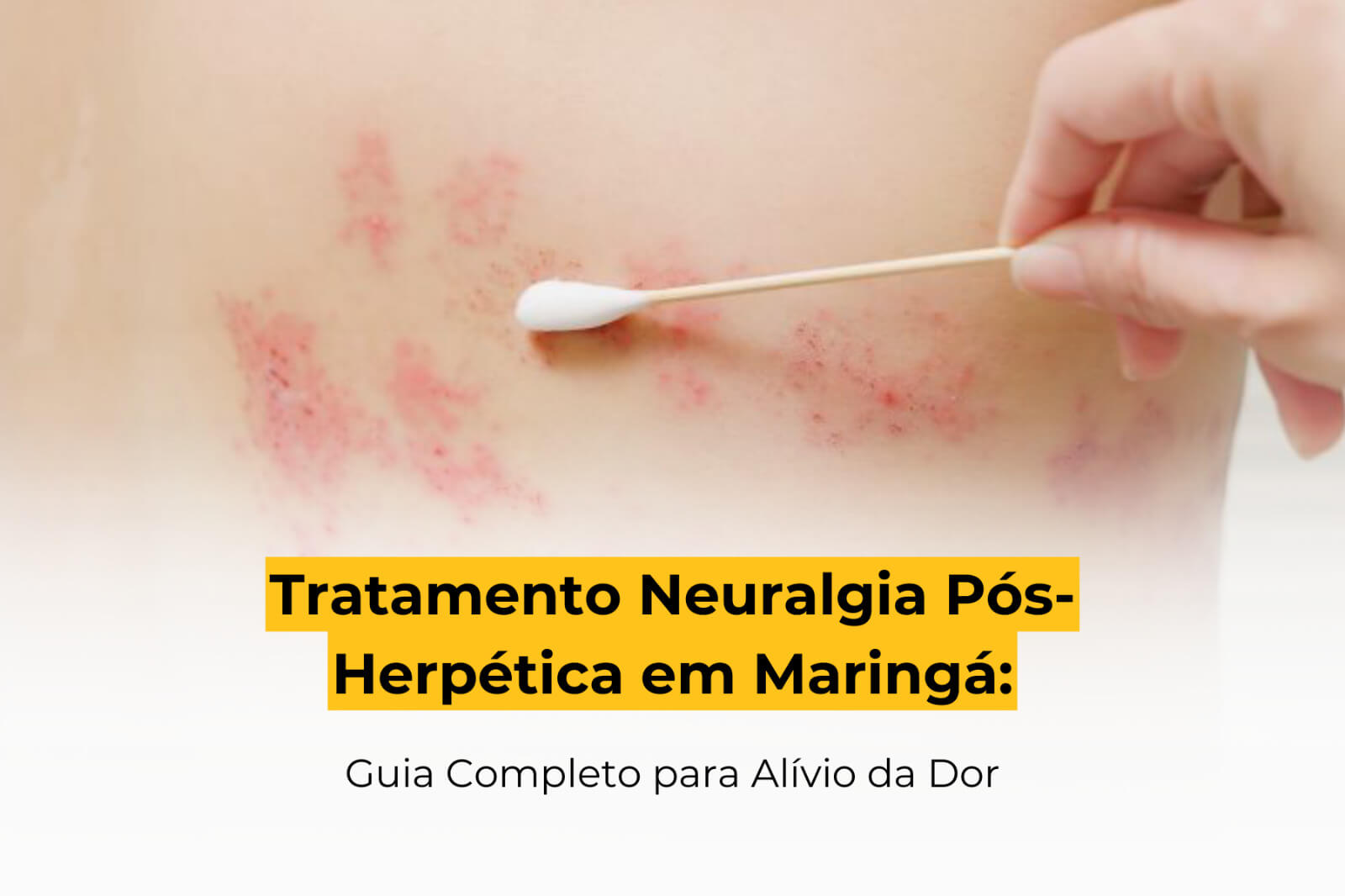 Tratamento Neuralgia Pós-Herpética em Maringá: Guia Completo para Alívio da Dor