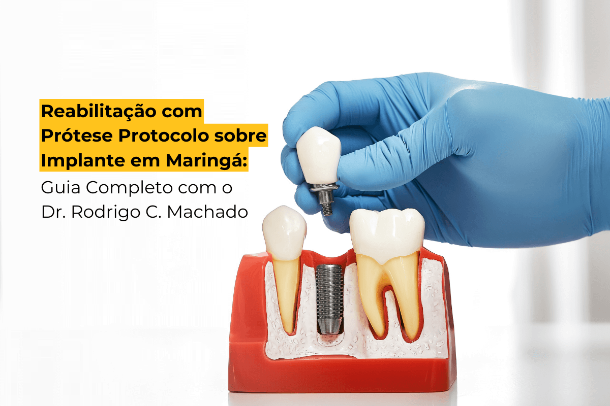 Reabilitação com Prótese Protocolo sobre Implante em Maringá: Guia Completo com o Dr. Rodrigo C. Machado